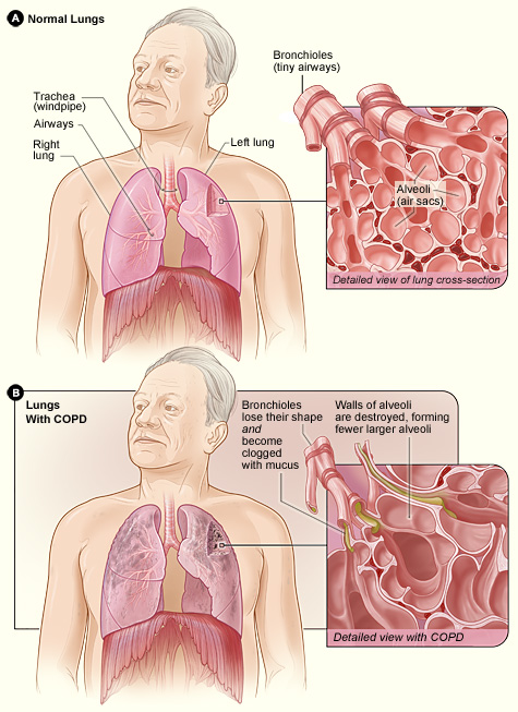 Difference between the lung of a COPD patient and an unaffected one. Image taken from NHLBI website (click on image to access the source)